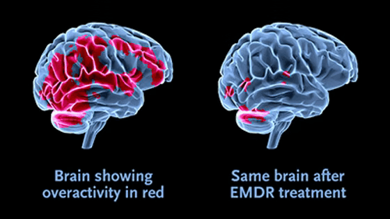 image of two brains - emdr